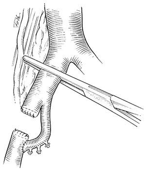 Revascularisation with ipsilateral internal iliac artery.
