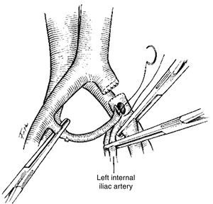 Revascularisation with internal iliac artery.