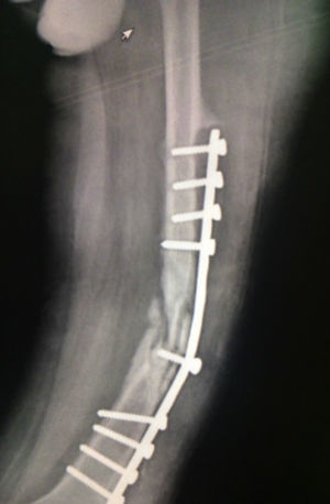 AP X-ray of the left femur with pseudarthrosis data and worn osteosynthesis material.