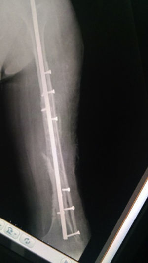 AP X-ray of the consolidated left femur.