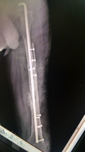 Lateral X-ray of the consolidated left femur.