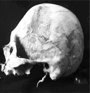 Skull in left lateral view, showing anteroposterior cultural flattening of the tabular erect type (Sak Tat rock-shelter)