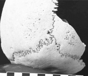 Spongy hyperostosis of both parietal bones of the cranial vault (Sak Tat rock-shelter)