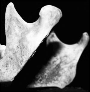 Unhealed chop mark of an adult mandible (Sak Tat rock-shelter)