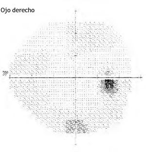 Campo visual oD en 2000. Afectación periférica del campo visual del ojo derecho sin pérdida de visión central.