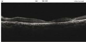 OCT lineal del ojo izquierdo tomado a los 11 días. se observa el cierre del agujero con restauración del contorno foveolar, presencia de lsR y la formación de una MER excéntrica.