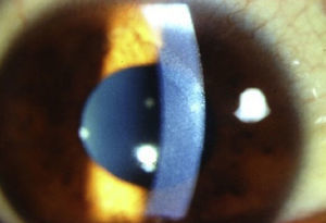 Opacidades corneales blanco-grisáceas en estroma corneal posterior (pre-Descemet), caso 1.