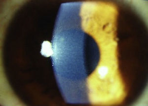 Opacidades corneales en estroma corneal posterior (pre-Descemet), caso 2.