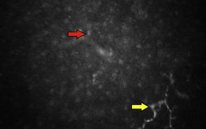 Microscopia confocal: corte de estroma posterior con presencia de abundantes núcleos de queratocitos con reflectividad alta y depósitos hiperreflectantes (flecha roja); así como fibras nerviosas de disposición vertical con morfología alterada (flecha amarilla).