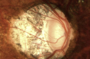 Fotografía de nervio óptico en un paciente miope con glaucoma; se nota una papila oblicua vertical con atrofia peripapilar amplia y una excavación vertical de 0.8.