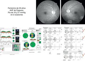 Caso clínico de mujer de 33 años, hipertensa ocular con estructuras aparentemente normales y escalón nasal persistente en serie de estudios.