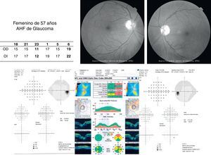 Caso clínico de mujer de 57 años de edad con AHF de glaucoma, curva horaria positiva tanto para picos hipertensivos como para variabilidad, con campos visuales normales y OCT alterado para el ojo izquierdo, con diagnóstico de glaucoma preperimétrico.