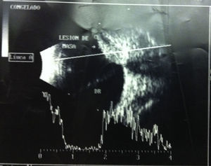Imagen de ultrasonido modo A-Scan: melanoma coroideo con forma de domo.