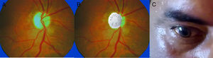 A y B. Examen de fondo de ojo; se observa papila pálida en «aspirina», signo de atrofia de nervio óptico. Fig. 1-C. Ojo derecho en midriasis arreactiva con la luz.