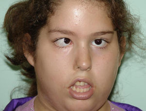 Caso clínico 1. Exploración preoperatoria.