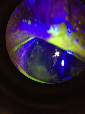Lesión dendritiforme en la tinción de fluoresceína.