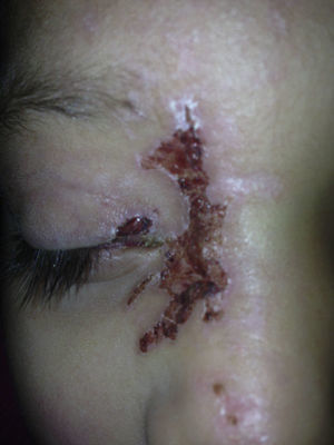 Herpes zóster en etapa de resolución.
