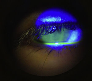 Epitelio corneal sin alteraciones aparentes.