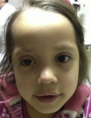 Ptosis derecha y resolución del cuadro clínico.