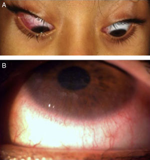 Paciente femenino de 8 años de edad con enfermedad asimétrica y síntomas de varios meses de evolución (A), mostrando una marcada vascularización superficial de la cornea inferior (B).