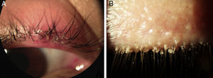 Chalazión aguda y foliculitis pustular (A), secreción «en collarines» (B).