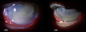 Aspecto del segmento anterior de ambos ojos en donde destaca la presencia de hipopion casi total de tonalidad verdosa e hiperemia marcada.
