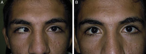 Paciente masculino de 18 años de edad. Esotropía derecha sensorial de 80 dioptrías prismáticas, comitante. Se le practicó retroimplante bimedial de 6mm con mioescleropexia retroecuatorial a nivel de vorticosas. A. Preoperatorio. B. Postoperatorio.