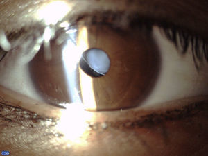 Fotografía clínica del segmento anterior con baja magnificación que evidencía la presencia de subluxación nasal superior del cristalino que fue la dirección más frecuente de subluxación del cristalino.