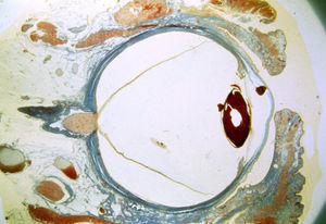 Corte histológico del globo ocular. Colección histopatológica ocular. Tricrómico de Masson. Harvard Medical School Fuente: Cogan Eye Pathology Lab. Dr. Rogelio Villarreal (1986) - Dr. Iván Vela.