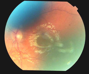 Edema de papila.