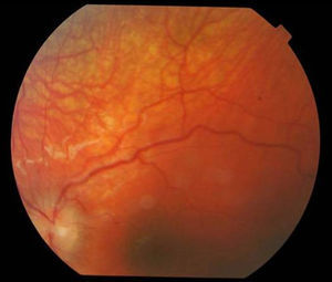 Edema de papila.