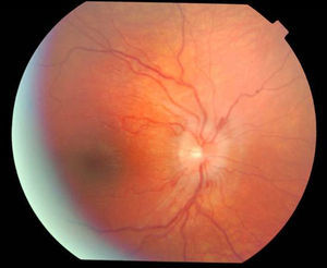 Edema de papila en resolución.