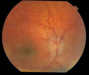 Edema de papila en resolución.
