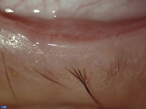 Foto clínica del borde palpebral del ojo derecho con aumento de 25× donde se evidencia la ausencia de orificios de salida de las glándulas de Meibomio.