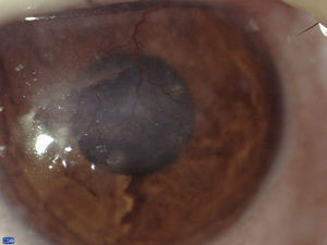 Foto clínica del segmento anterior y córnea del ojo izquierdo en donde se observa un leucoma central con vascularización superficial importante.