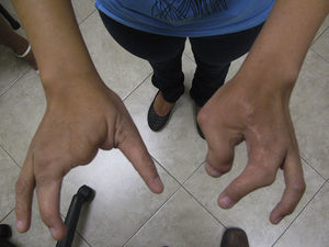 Foto clínica de ambas manos que evidencian la presencia de ectrodactilia y deformidad en tenaza de langosta.