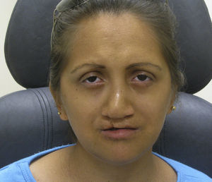 Foto clínica de la cara donde se evidencia la presencia de una cicatriz en el labio superior por la reparación quirúrgica del labio hendido además de madarosis en ambos ojos.