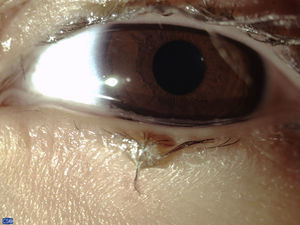 Foto clínica del globo ocular y anexos de la segunda paciente con aumento 6× donde se nota la presencia de madarosis, distriquiasis, abundante secreción mucosa tanto en las pestañas como en el borde del párpado inferior y ausencia de los orificios de salida de las glándulas de Meibomio.