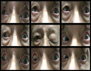 Fotografía clínica que muestra las 9 posiciones de la mirada donde se observa ausencia de ducciones horizontales, verticales y torsionales del ojo izquierdo.