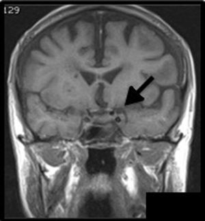 RMI coronal que muestra realce de las vainas meníngeas, de la pared del seno cavernoso izquierdo, con acúmulo de contraste y afección de las estructuras neurovasculares.
