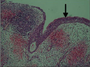 Corte histológico con tinción de hematoxilina y eosina que muestra epitelio ciliado pseudoestratificado engrosado que forma la pared del mucocele, con abundante reacción inflamatoria y extravasación eritrocitaria.