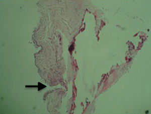 Corte histológico que muestra un área de epitelio denudada con adelgazamiento del estroma subyacente de la mucosa nasal y erosión hacia el tejido óseo que confirma el mucocele.