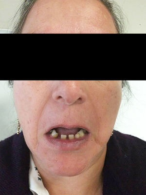 Alteraciones dentales características del síndrome.