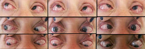 Movimientos oculares. Endotropia 50DP e hipertropia 15DP en posición al frente.
