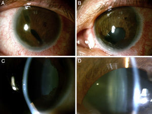 A. Segmento anterior ojo derecho mostrando policoria y B, ojo izquierdo mostrando corectopia. Ambos casos con embriotoxón posterior. C y D. Catarata de ambos ojos.