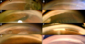 A-H. Gonioscopia de los distintos sectores de ambos ojos mostrando sinequias anteriores periféricas.