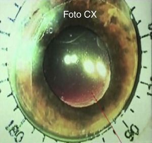 Foto de video quirúrgico, midiendo con anillo de Méndez.
