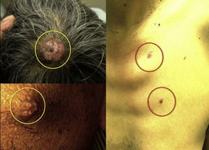 Lesiones nodulares, elevadas, hiperémicas, vascularizadas, en región malar derecha, cuero cabelludo y tórax anterior.