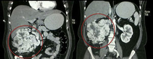 TAC de abdomen, 2 imágenes que muestran masa tumoral a expensas de riñón derecho, de aproximadamente 9×10mm, que involucran parénquima.
