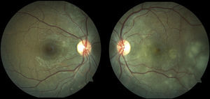 Imágenes clínicas de polo posterior donde se aprecian lesiones predominantemente en OS sugestivas de desprendimientos localizados serosos de retina.